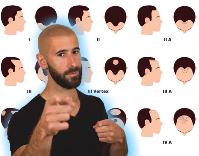 The-Norwood-scale-for-hair-loss-802x630